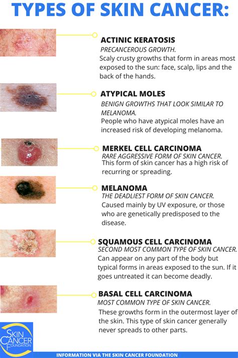 皮膚癌|Skin Cancer: Symptoms, Types & Treatment